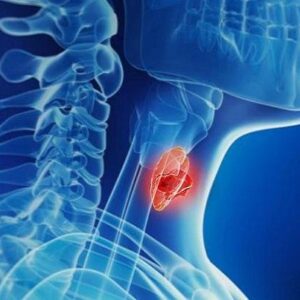 افزایش آمار تشخیص بدخیمیهای تیروئیدی افزایش آمار تشخیص بدخیمیهای تیروئیدی