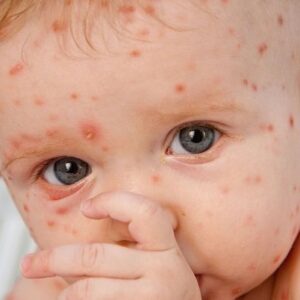 شیوع «آبله مرغان» در بهار